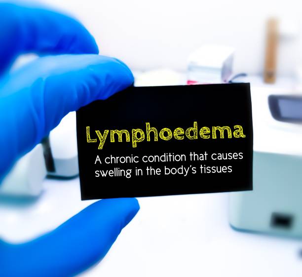 Understanding Lymphedema: The Silent Condition Affecting Millions: And How It’s Treatable