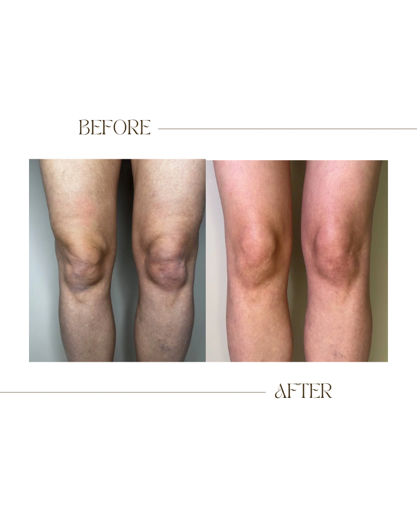 Knee Area