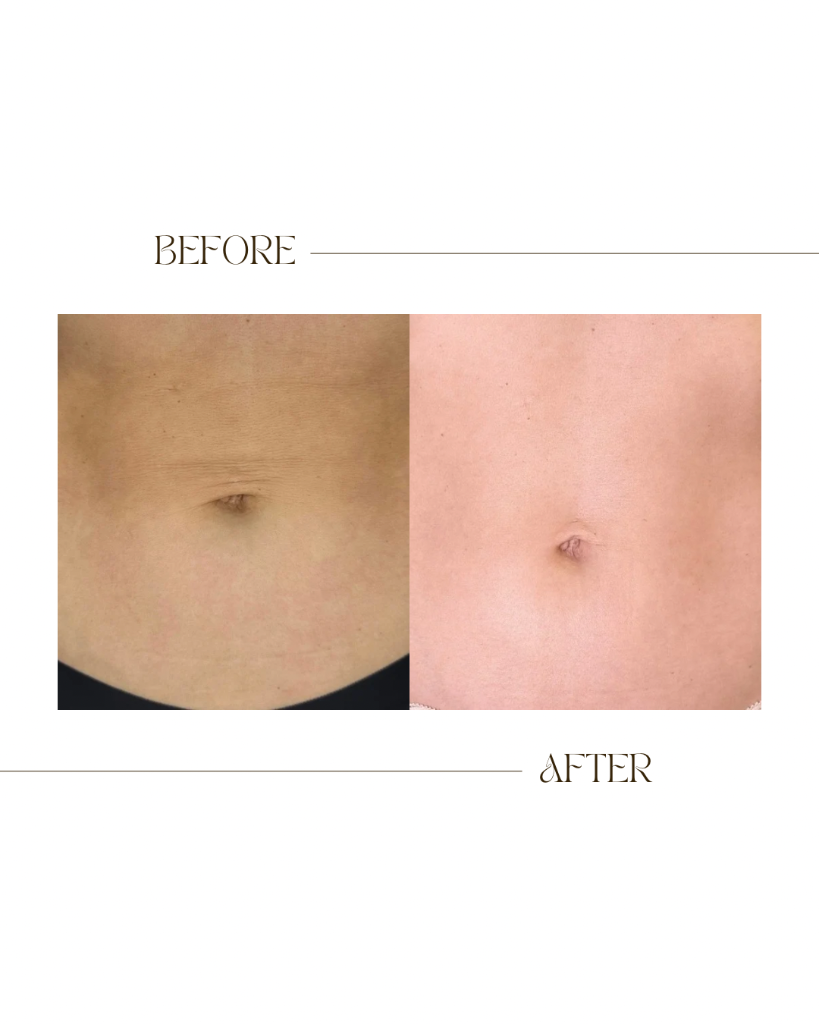 Body Skin Tightening