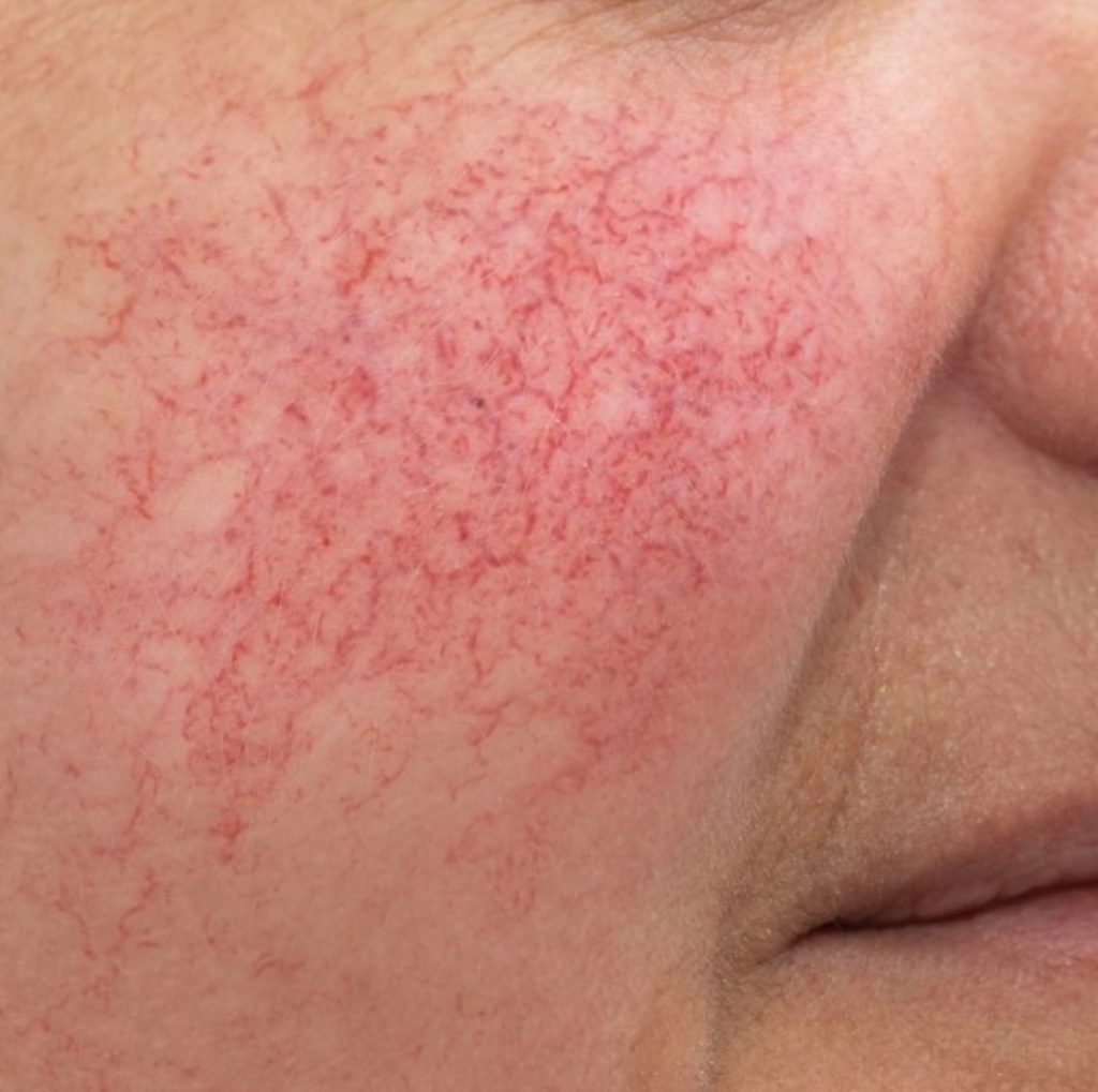 Blood Vessels / Redness