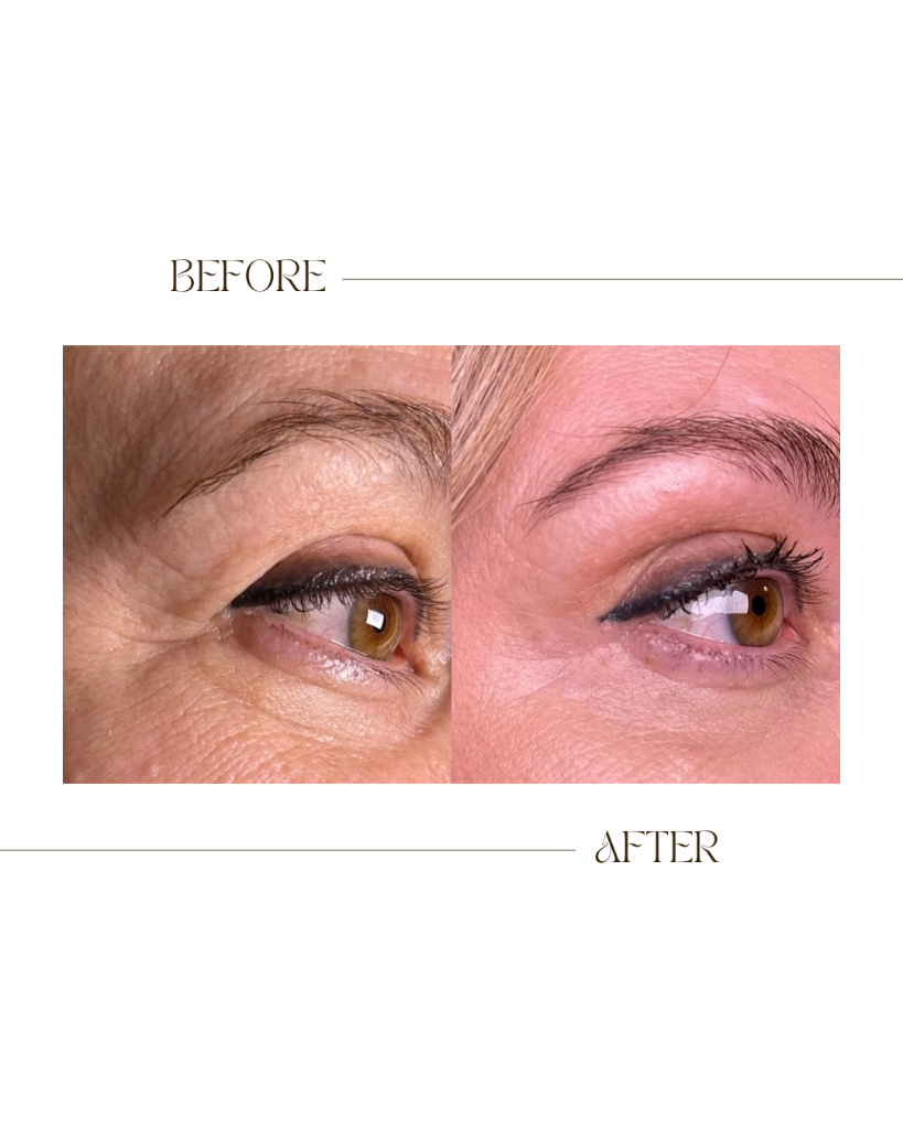 Area around Eyes