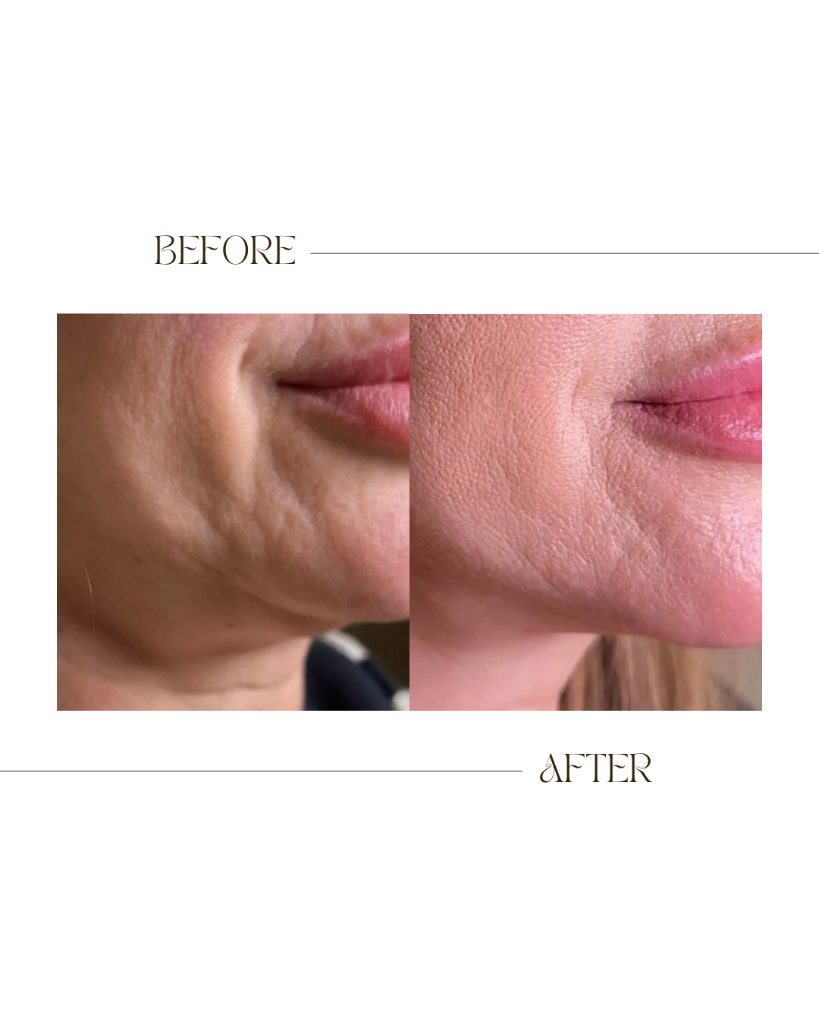 Chin Area