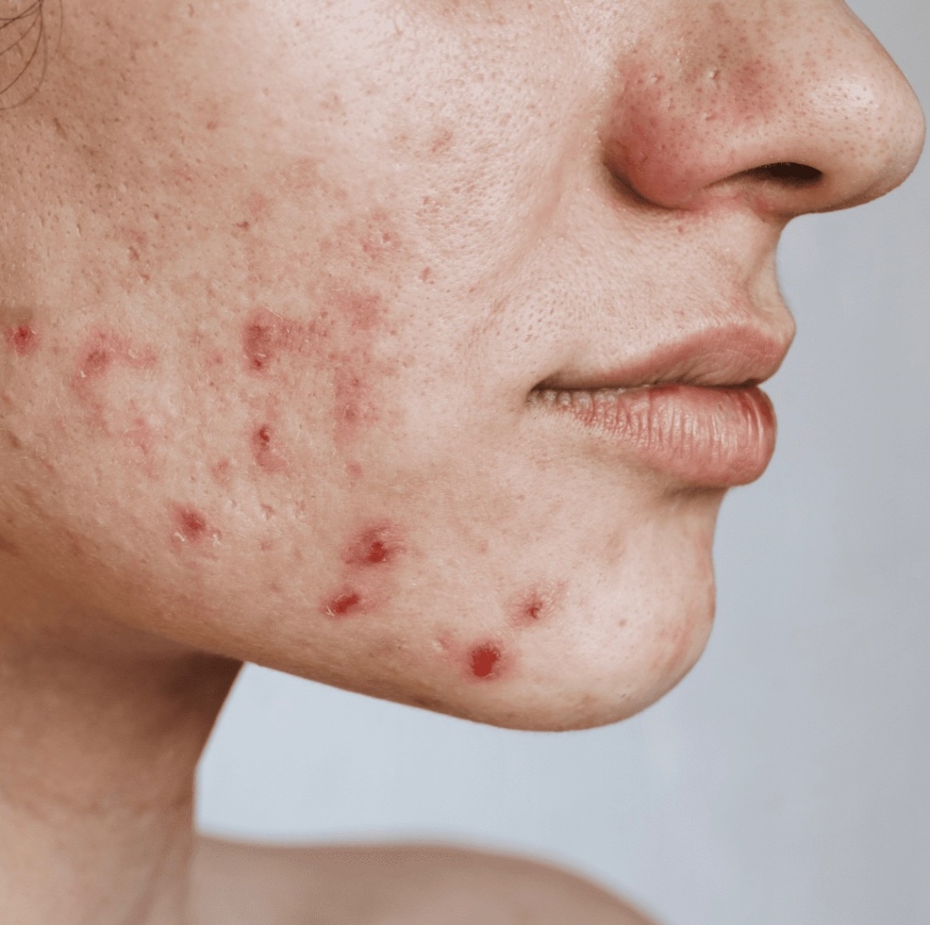 Post-Acne