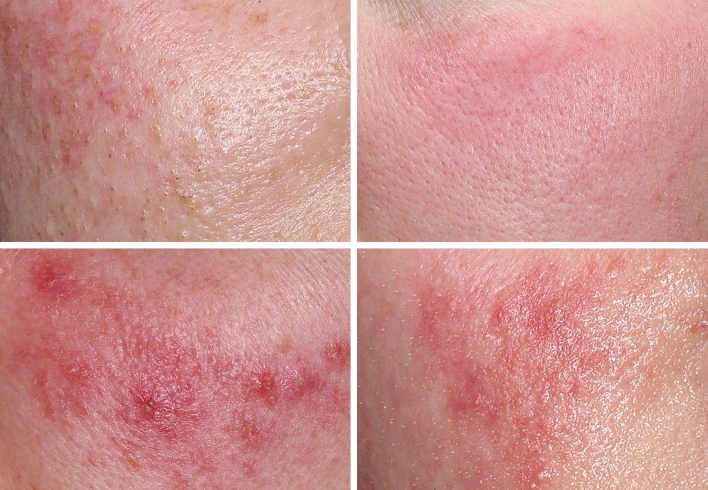 Diferentes subtipos de rosácea facial — eritema, pápulas, telangiectasias
