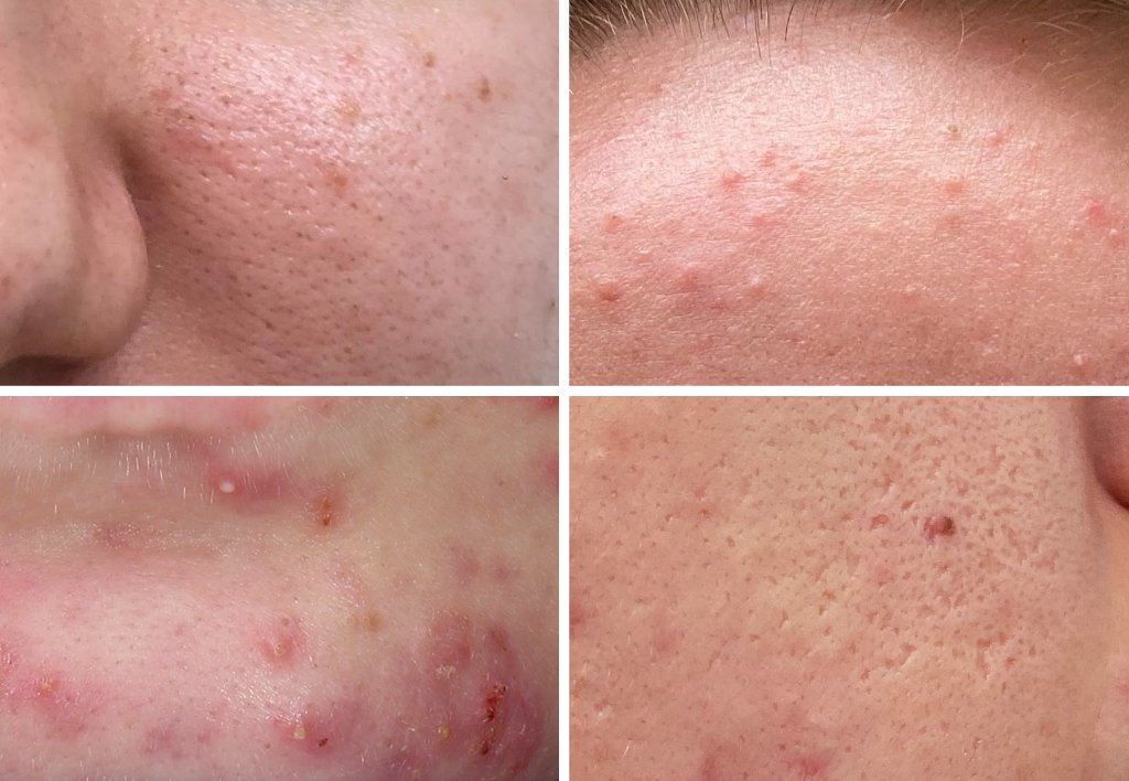 Diferentes tipos de acné — pápulas, comedones, acné inflamatorio
