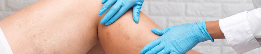 Spider Veins vs. Varicose Veins: What's the Difference and How Are They Treated?