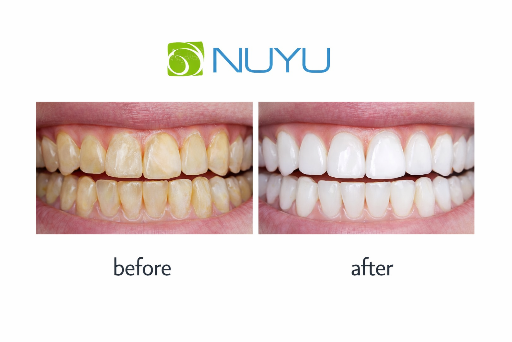 Teeth Whitening