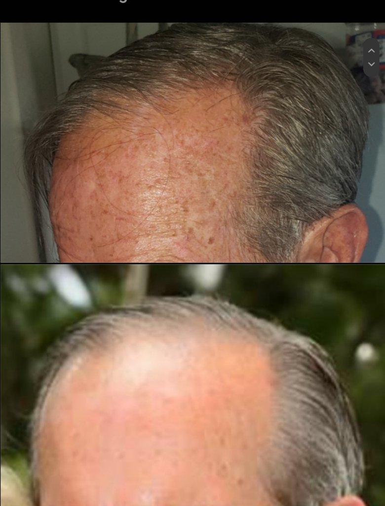 Hair growth results