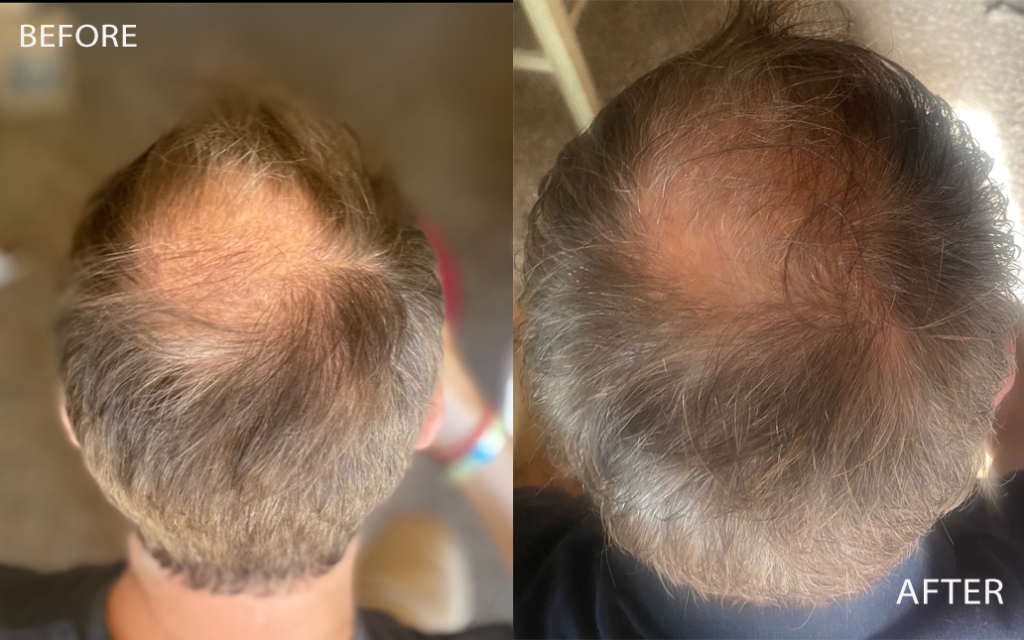 Hair growth - 4 weeks