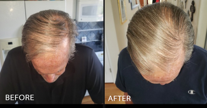 Hair growth - 2 months
