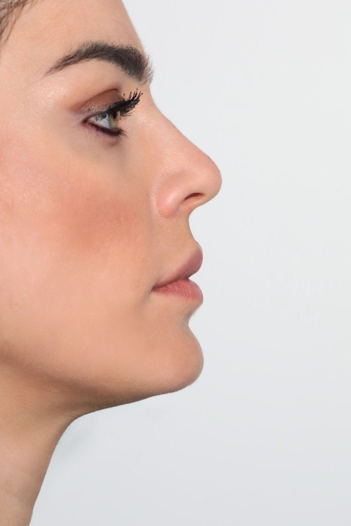 Microneedling Napoli - Centro Maresca Corsaro