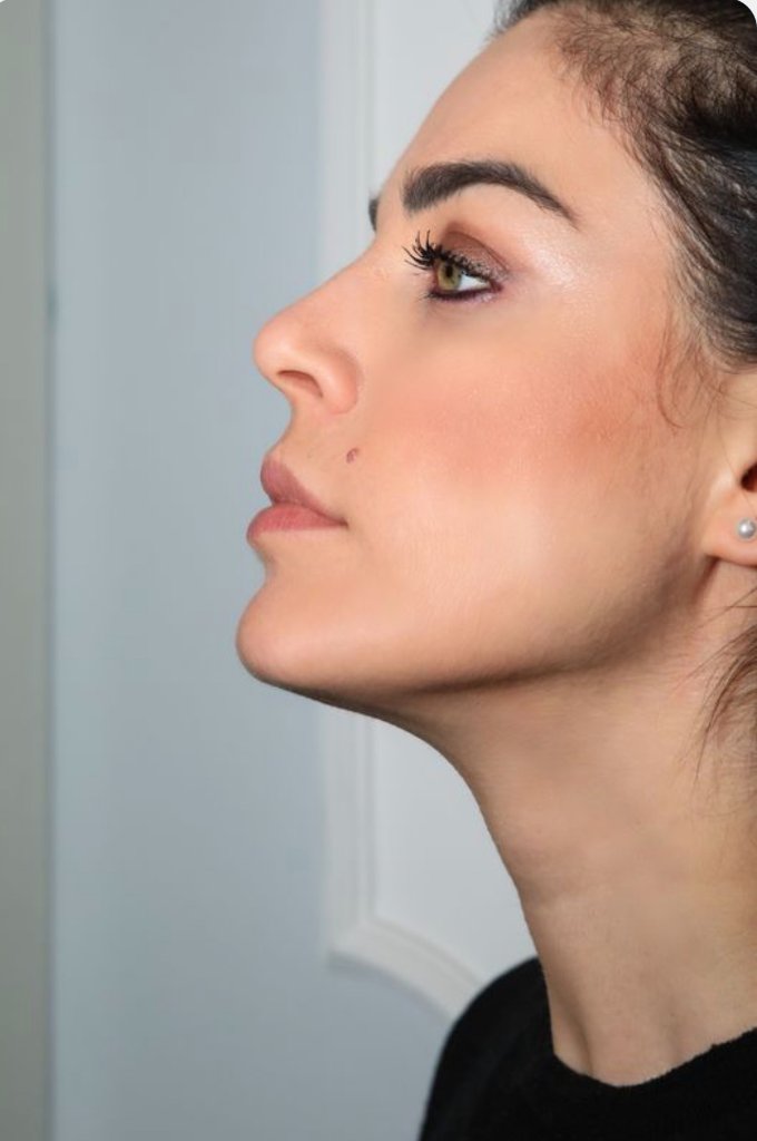 Lipofilling del Contorno Mandibolare Napoli - Centro Maresca Corsaro