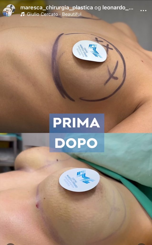 Mastoplastica - Prima e Dopo Mastoplastica - Prima e Dopo - Video testimonianza paziente Centro Maresca Corsaro