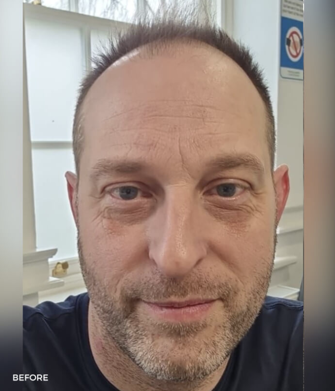 Before treatment