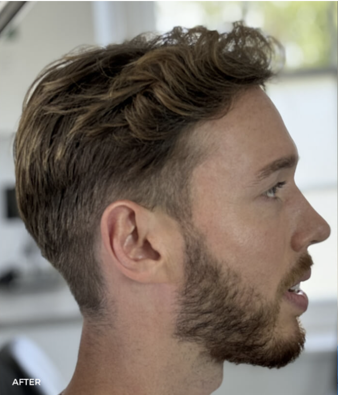 After — Frontal Thirds