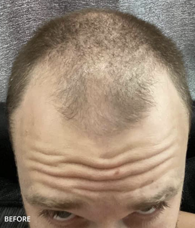 Before — Hairline & Frontal