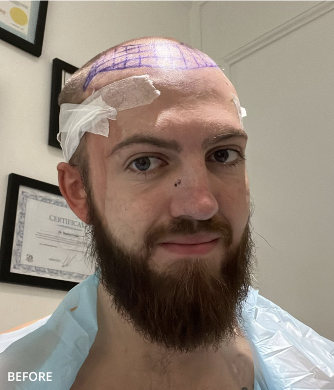 Before — Full Crown Coverage