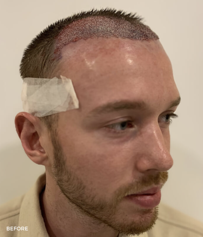 Before — Frontal Thirds