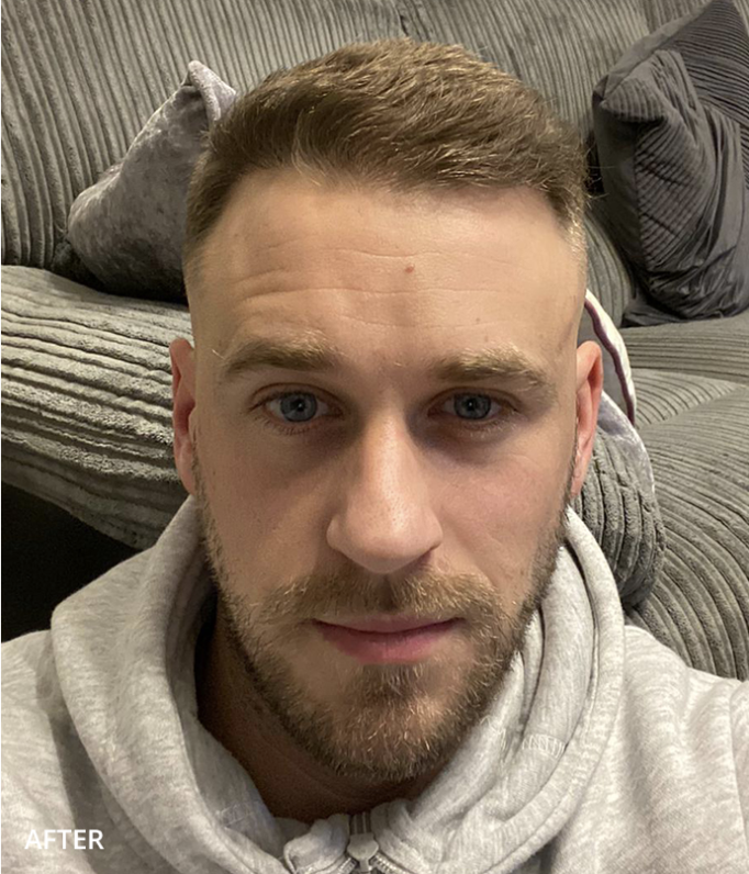 After — Hairline & Frontal