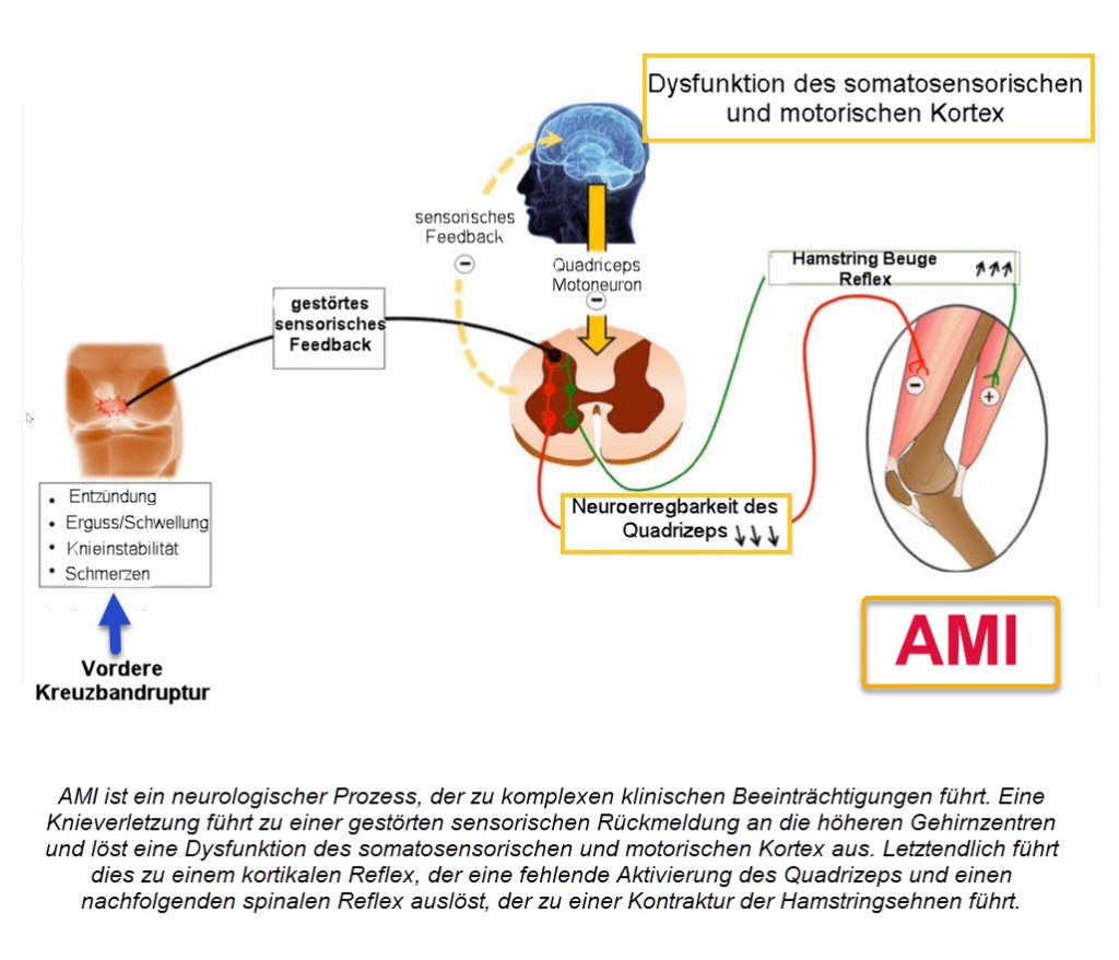 Arthrogene Muskelinhibition Diagram