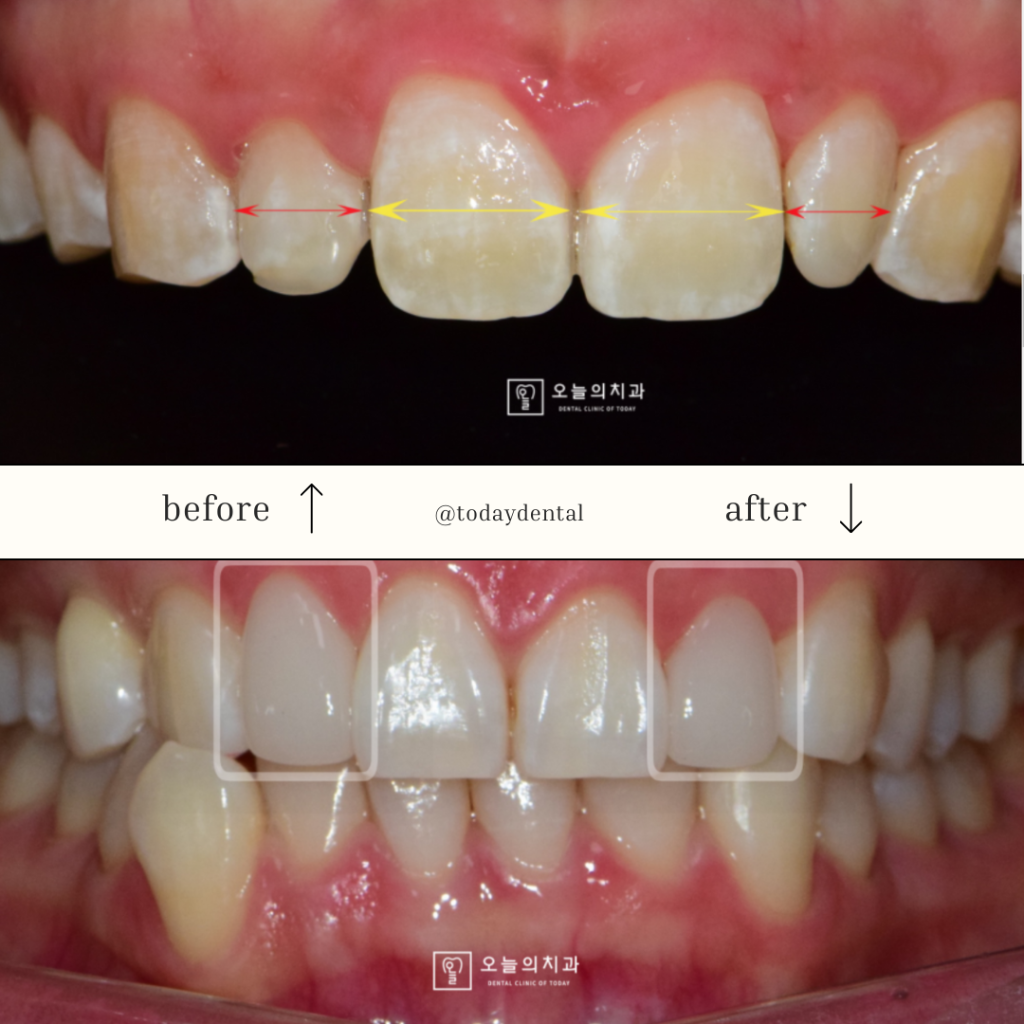 Today Dental · Laminate-veneer treatment record 02 · After treatment