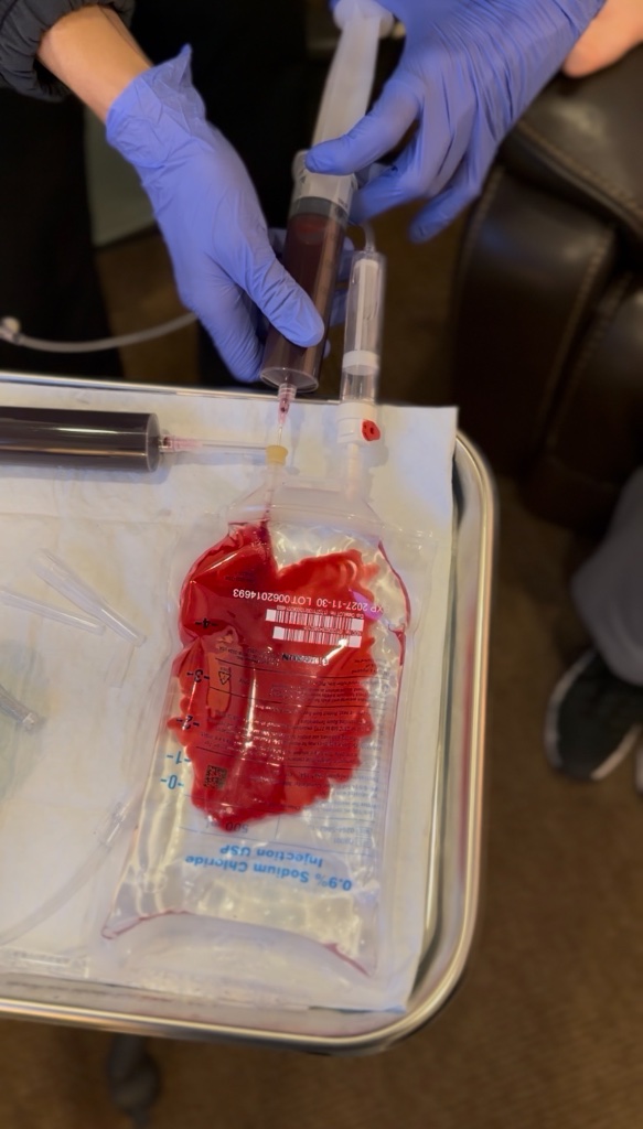 IV Ozone Therapy Treatment
