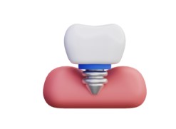 Implantation
