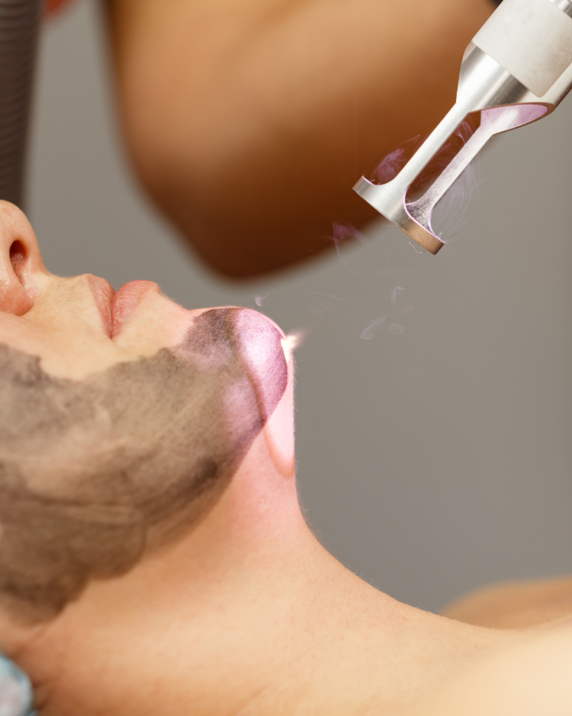 Carbon Laser Facial