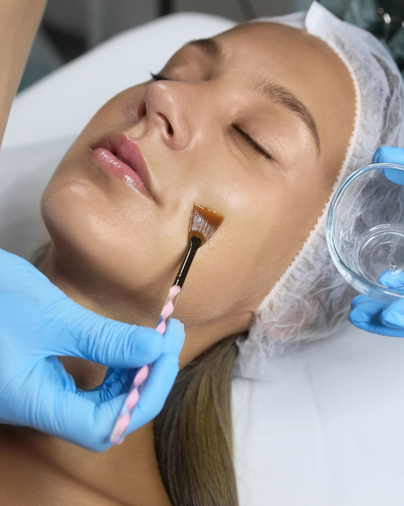 Chemical Peels
