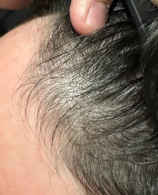 Hair restoration after
