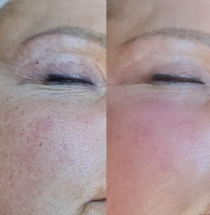Before and after dark spots treatment