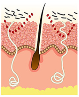 Skin renewed after treatment