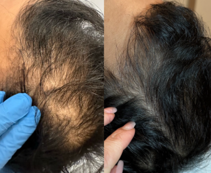 Hair restoration results