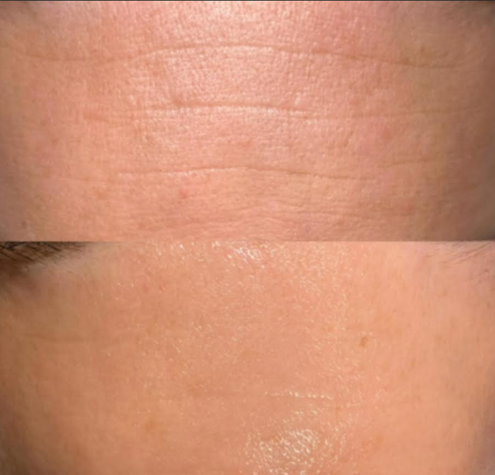 Microneedling and Polynucleotides before and after