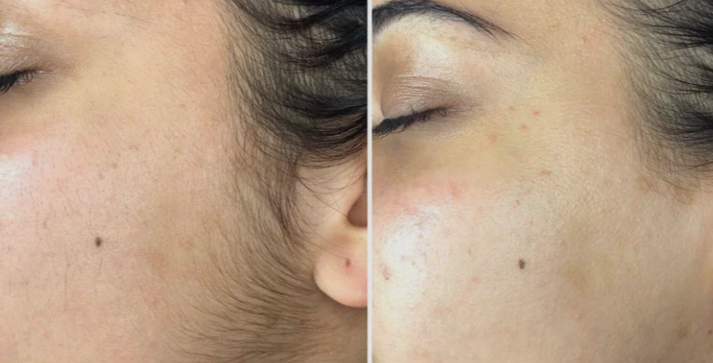 Dermaplaning Treatment