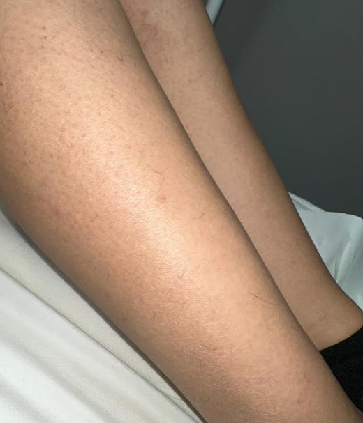 Laser hair removal results - legs