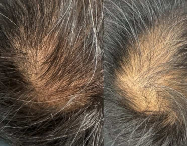 Hair restoration results