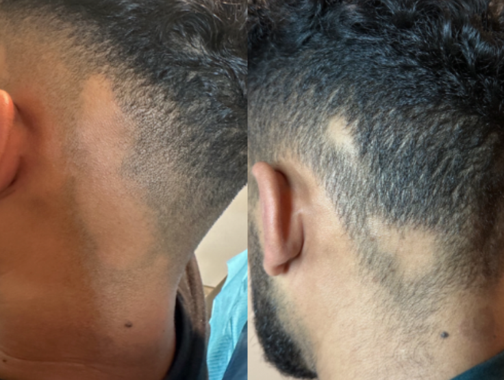 Hair restoration results