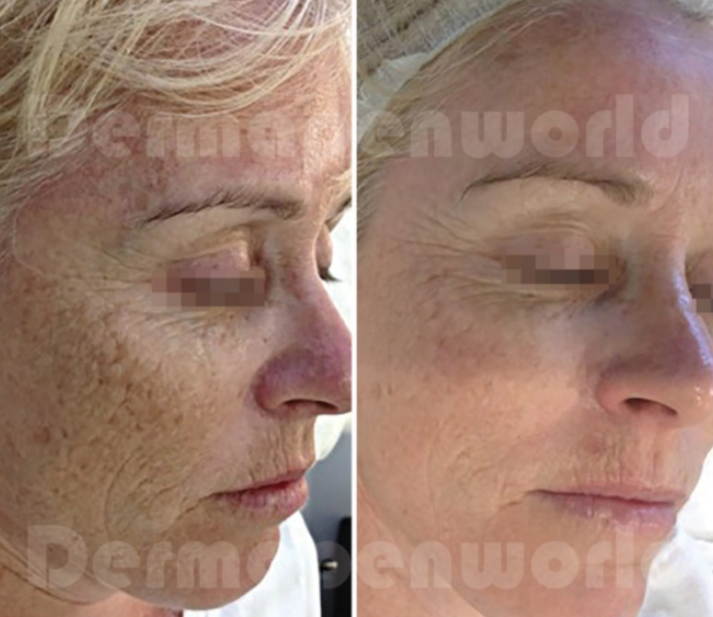 Before and after acne scarring treatment