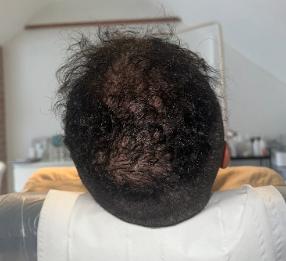 Hair restoration