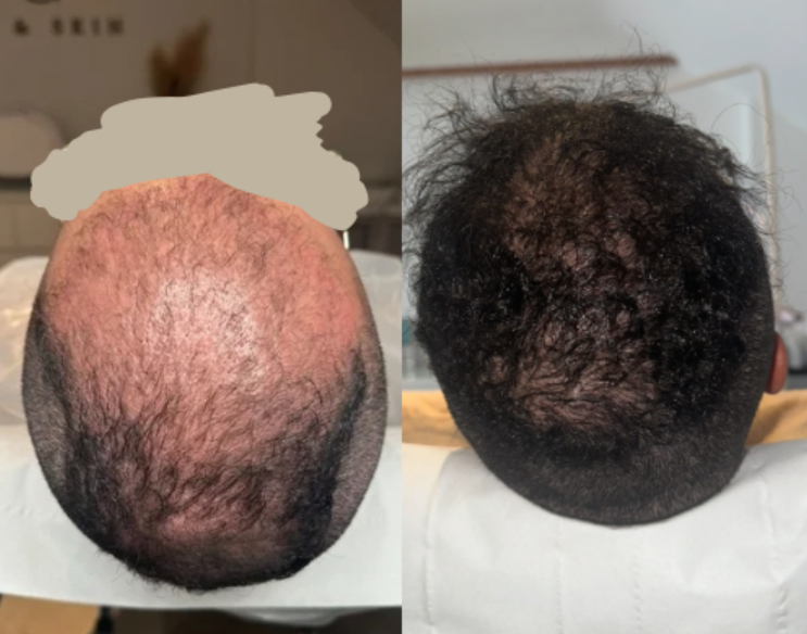 Hair restoration results