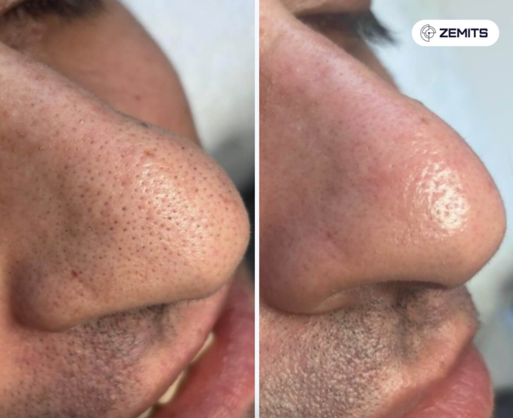 Congested skin to clear pores
