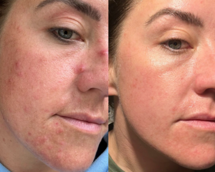 PRP Hydrofacials and personalised home care before and after