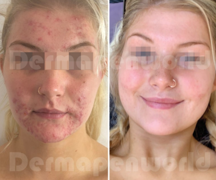 Before and after active acne treatment