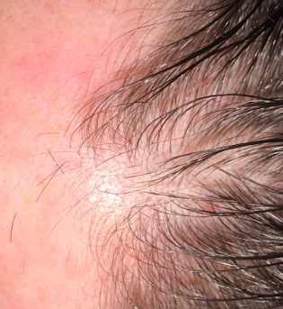 Hair restoration before