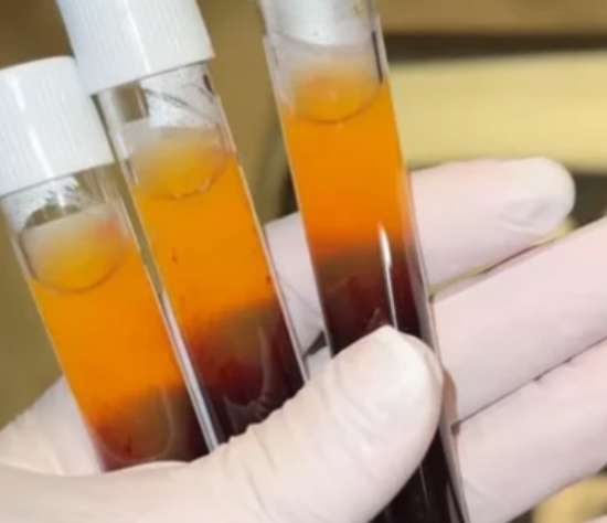 PRP Hair Restoration