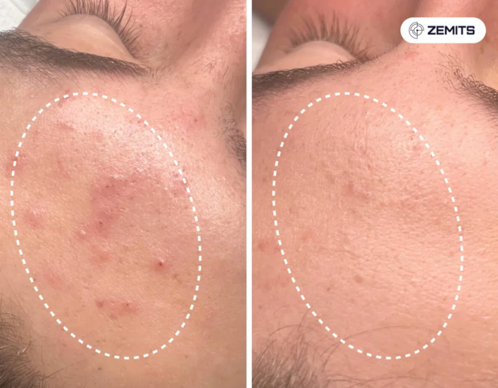 Acne breakout improvement