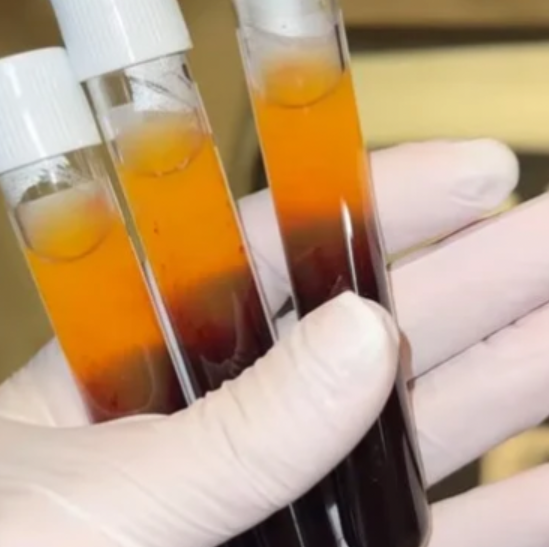 PRP Vampire Facial