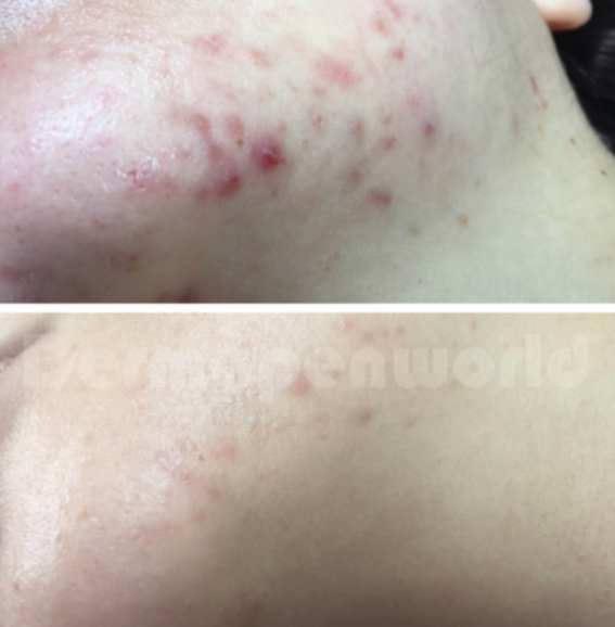 Before and after overall skin rejuvenation