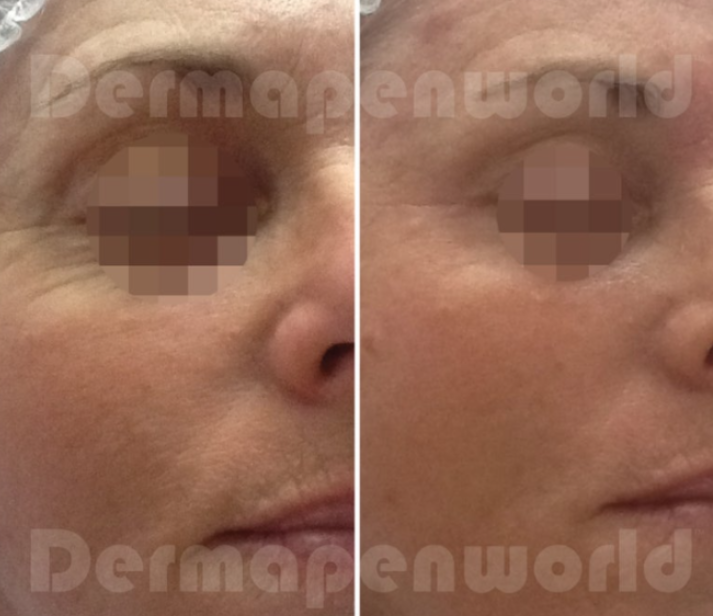 Before and after fine lines treatment